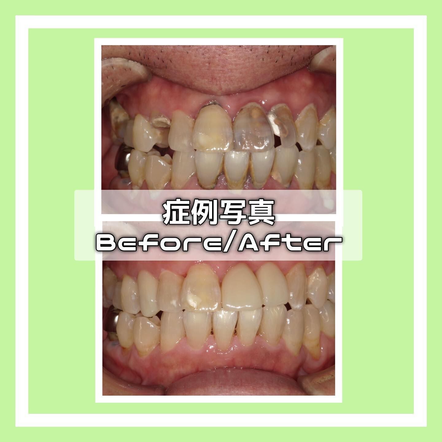 症例写真(Before/After)🦷
