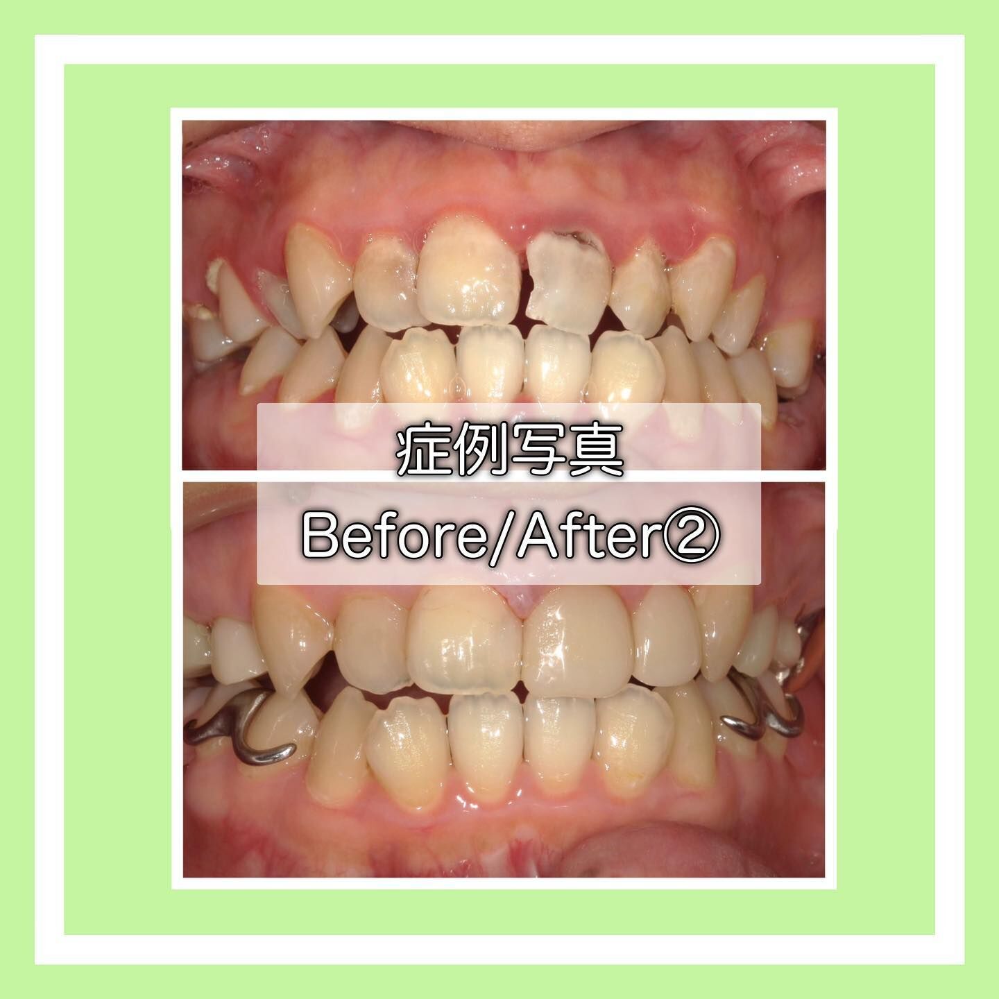症例写真(Before/After)②🦷
