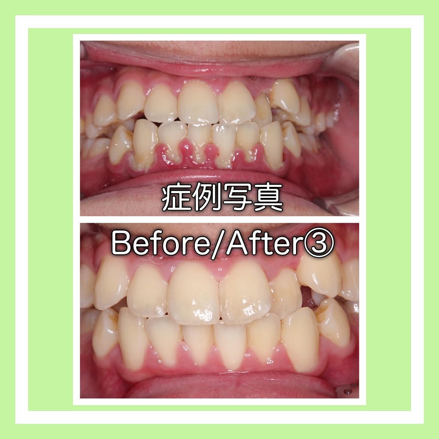 症例写真(Before/After)③🦷