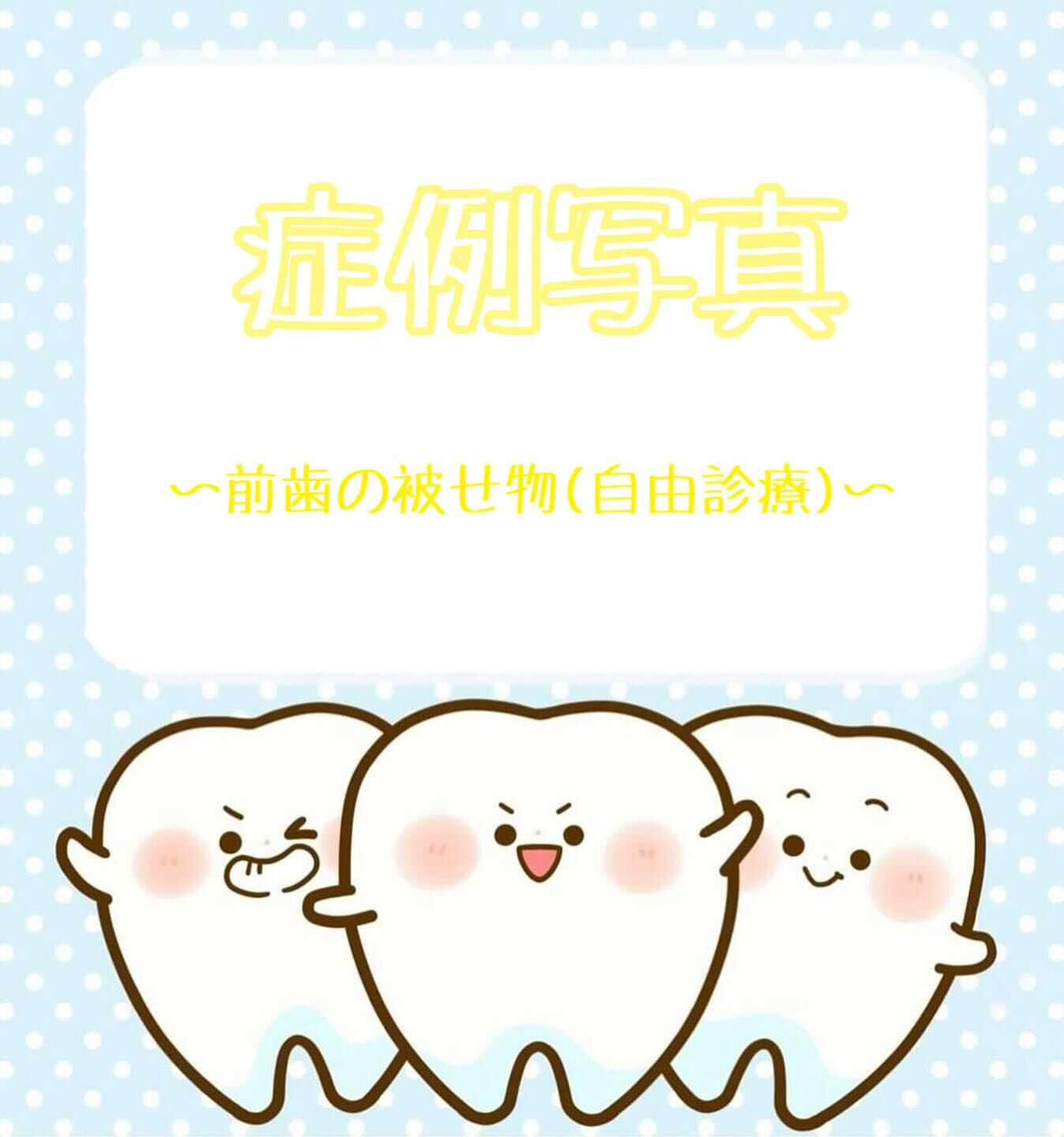 症例写真〜前歯の被せ物(自由診療)〜