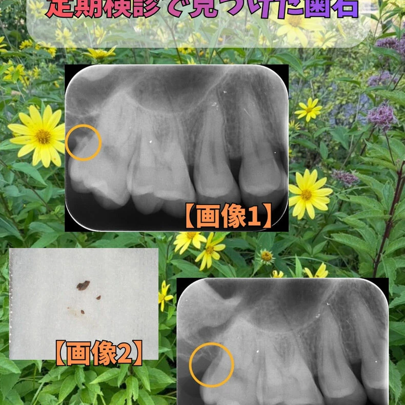 画像2278：定期検診の際に見つけた歯石についてです👀