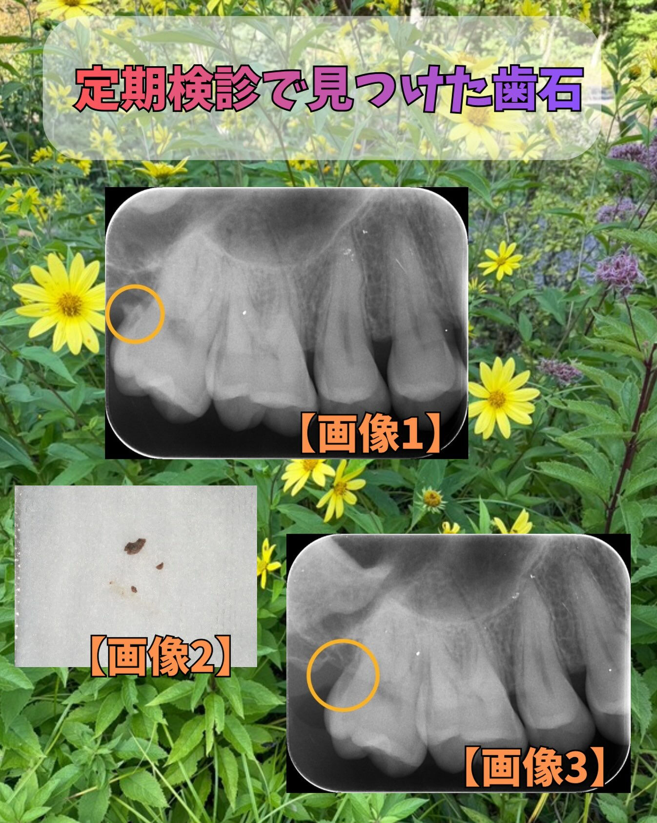 定期検診の際に見つけた歯石についてです👀