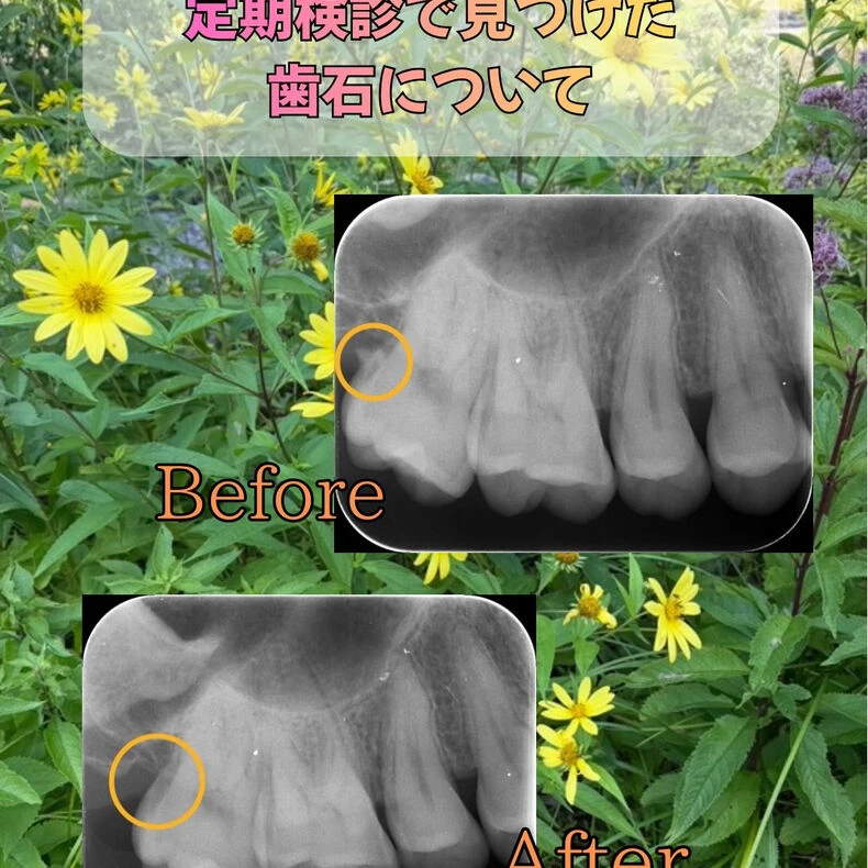 画像2280：定期検診の際に見つけた歯石についてです👀