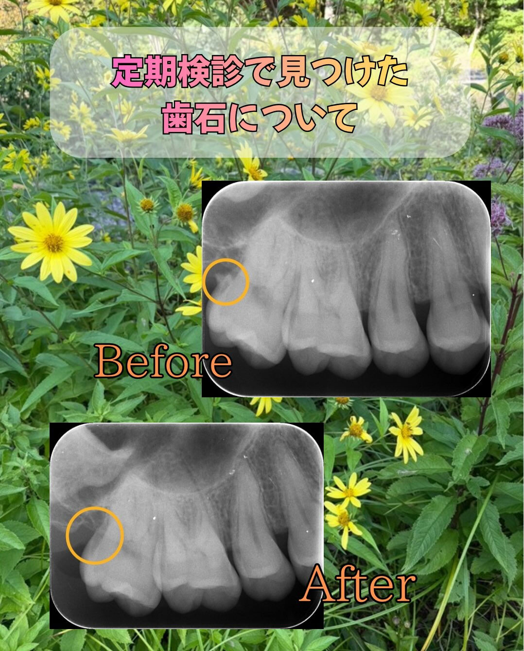 定期検診の際に見つけた歯石についてです👀