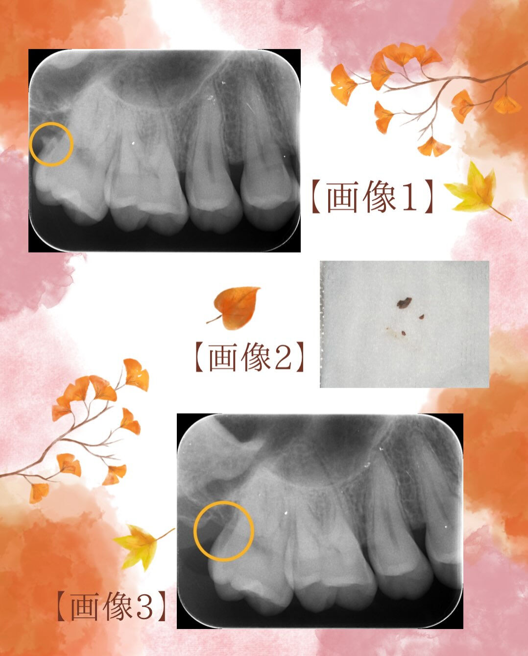 定期検診の際に見つけた歯石についてです👀