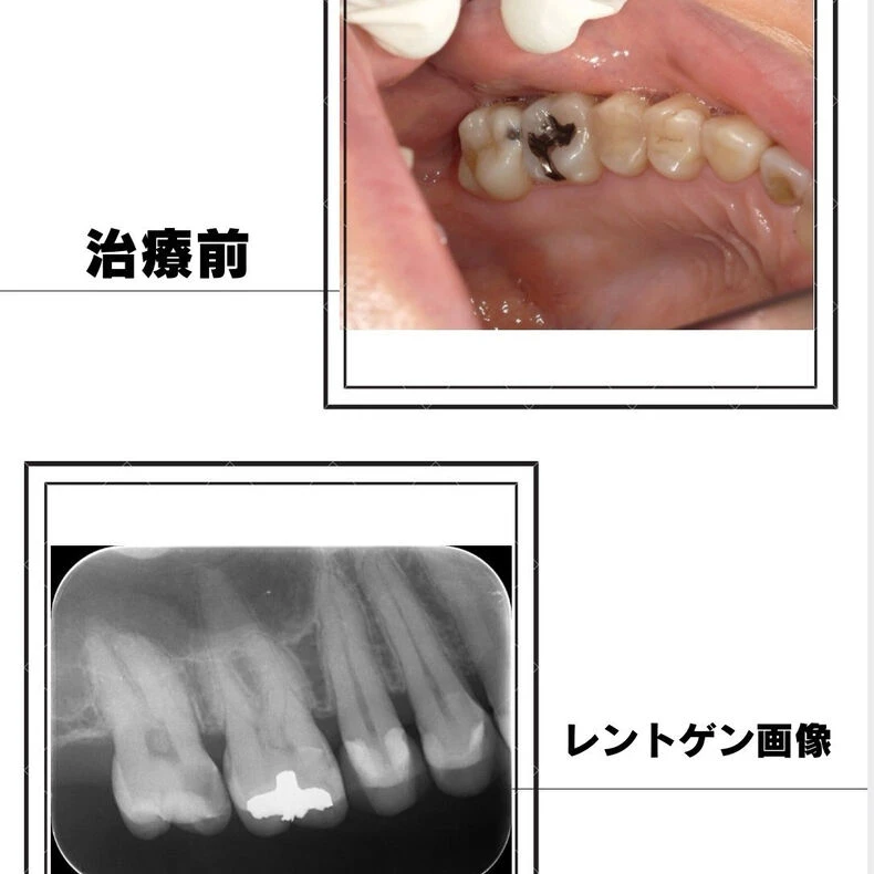 画像2307：歯が沁みて痛い、という主訴の方のお写真です👀