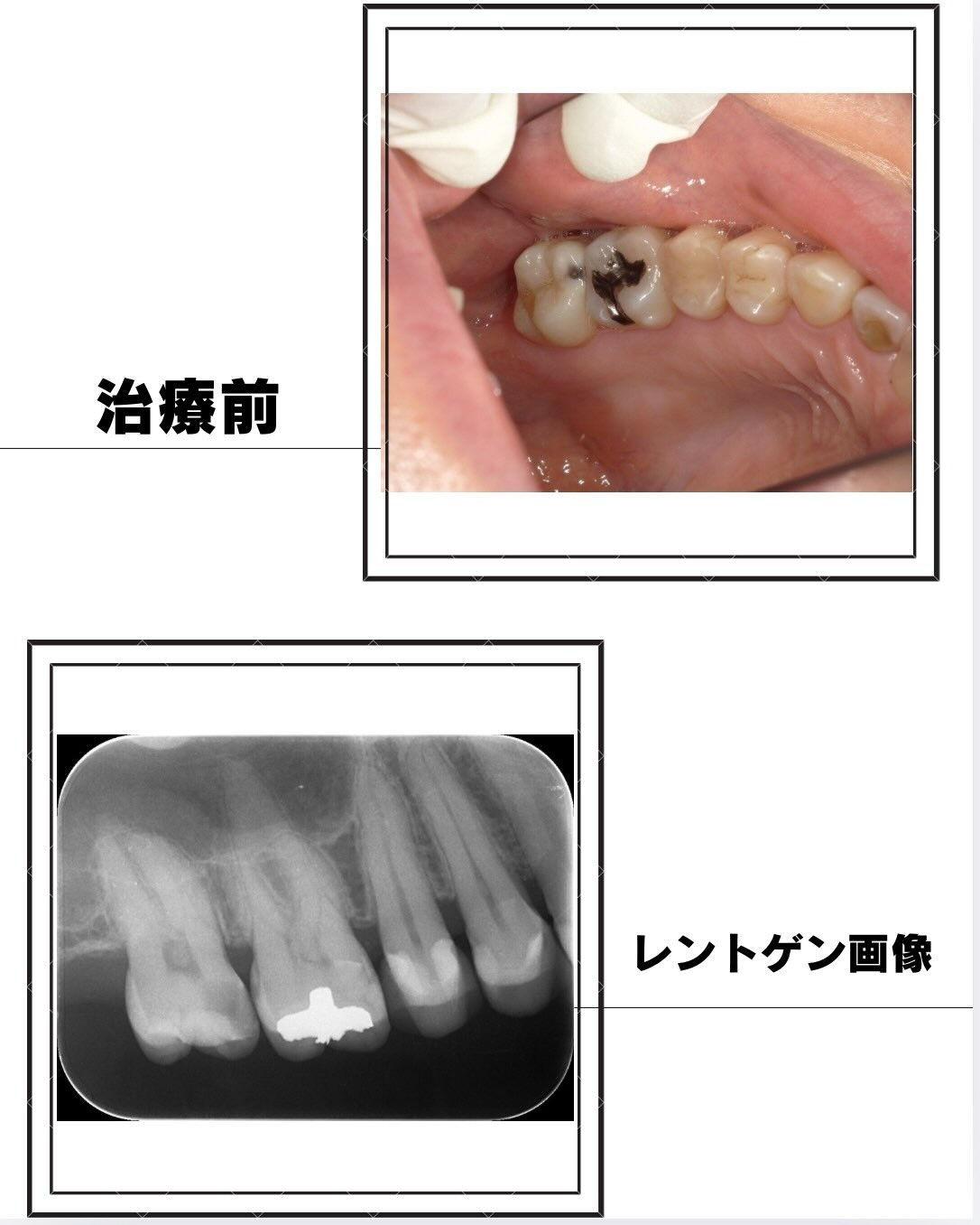 歯が沁みて痛い、という主訴の方のお写真です👀