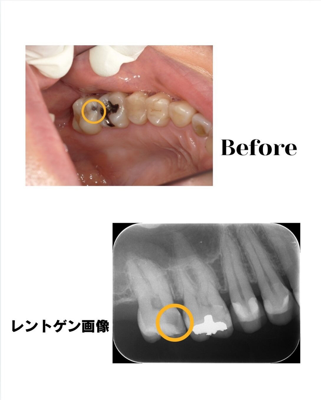 歯が沁みて痛い、という主訴の方のお写真です👀