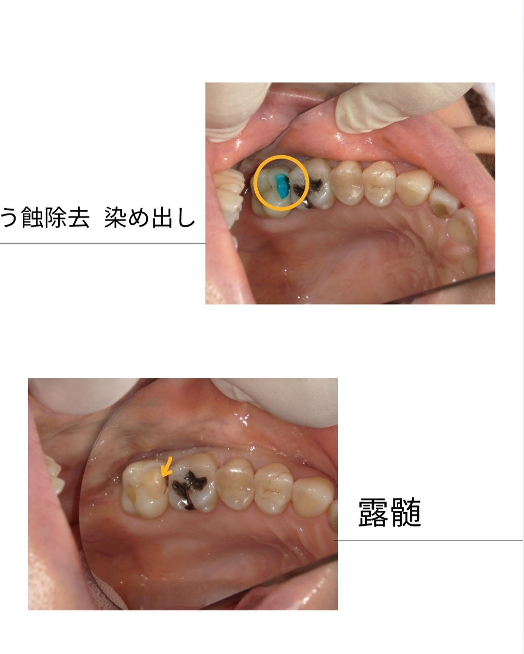 歯が沁みて痛い、という主訴の方のお写真です👀