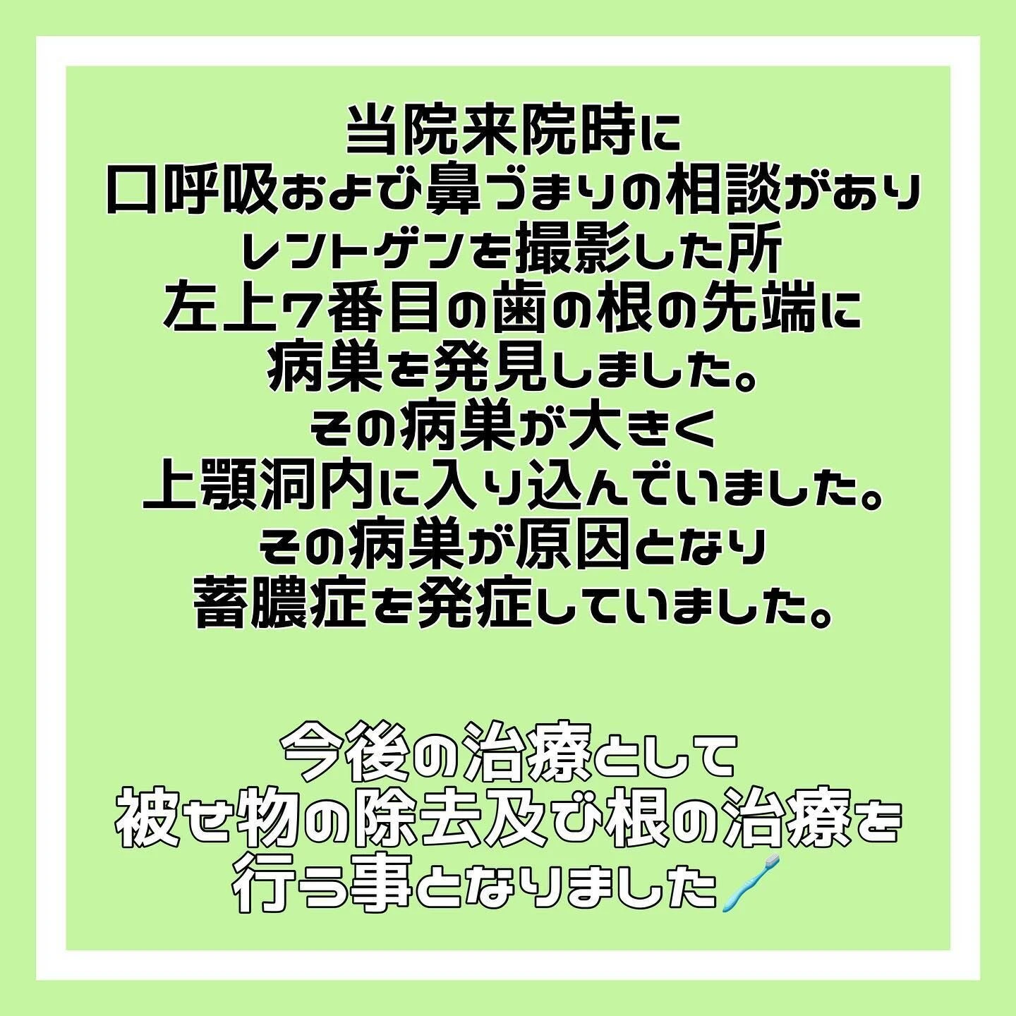 「歯性上顎洞炎」について🦷