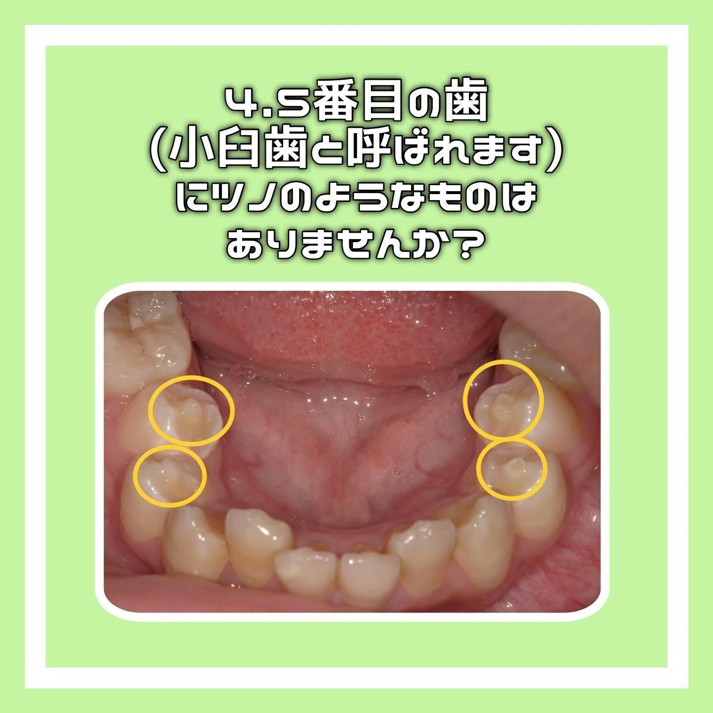 「中心結節」について🦷✨