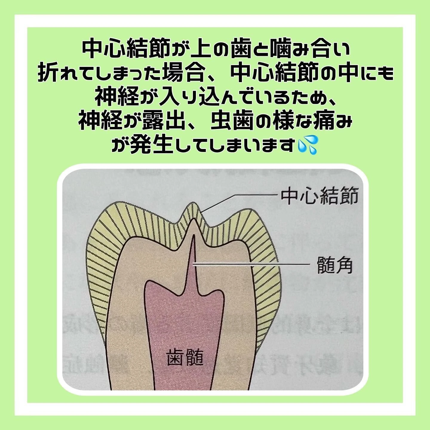 「中心結節」について🦷✨