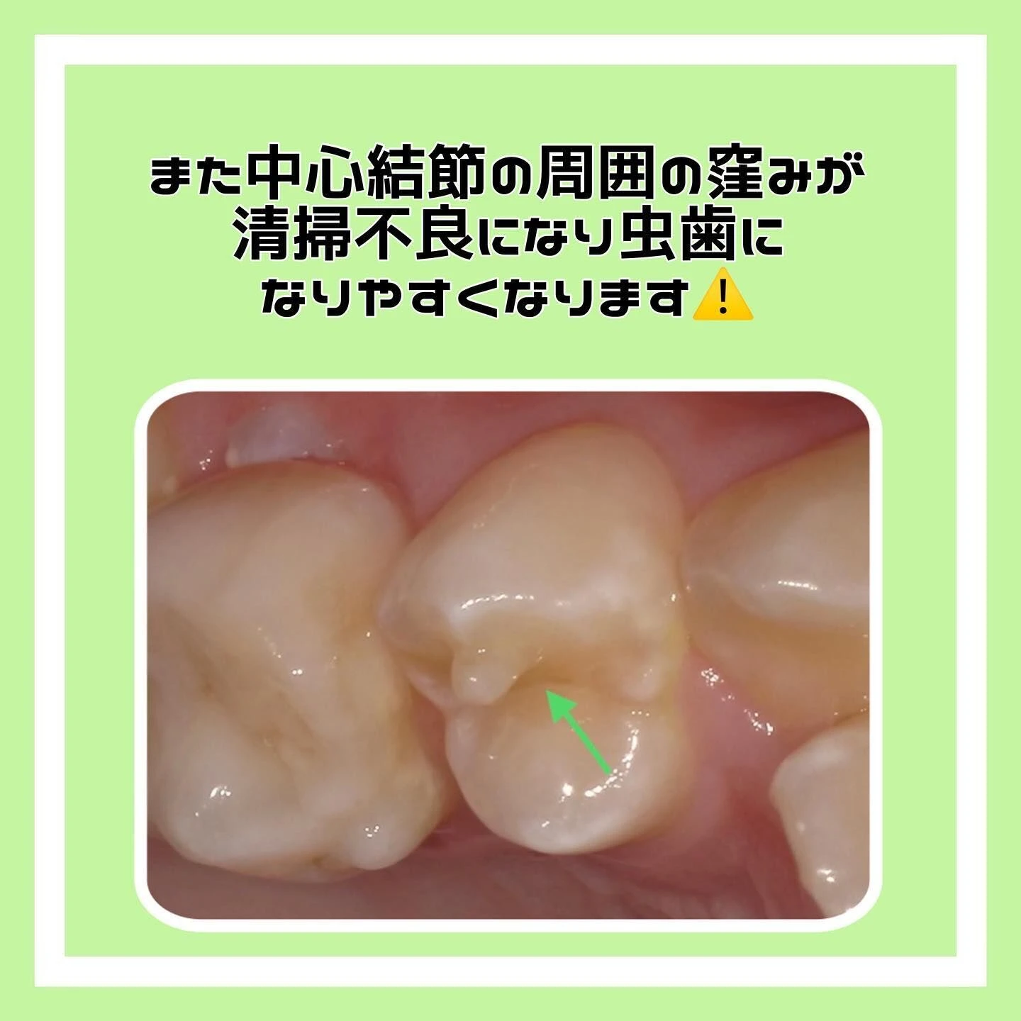 「中心結節」について🦷✨