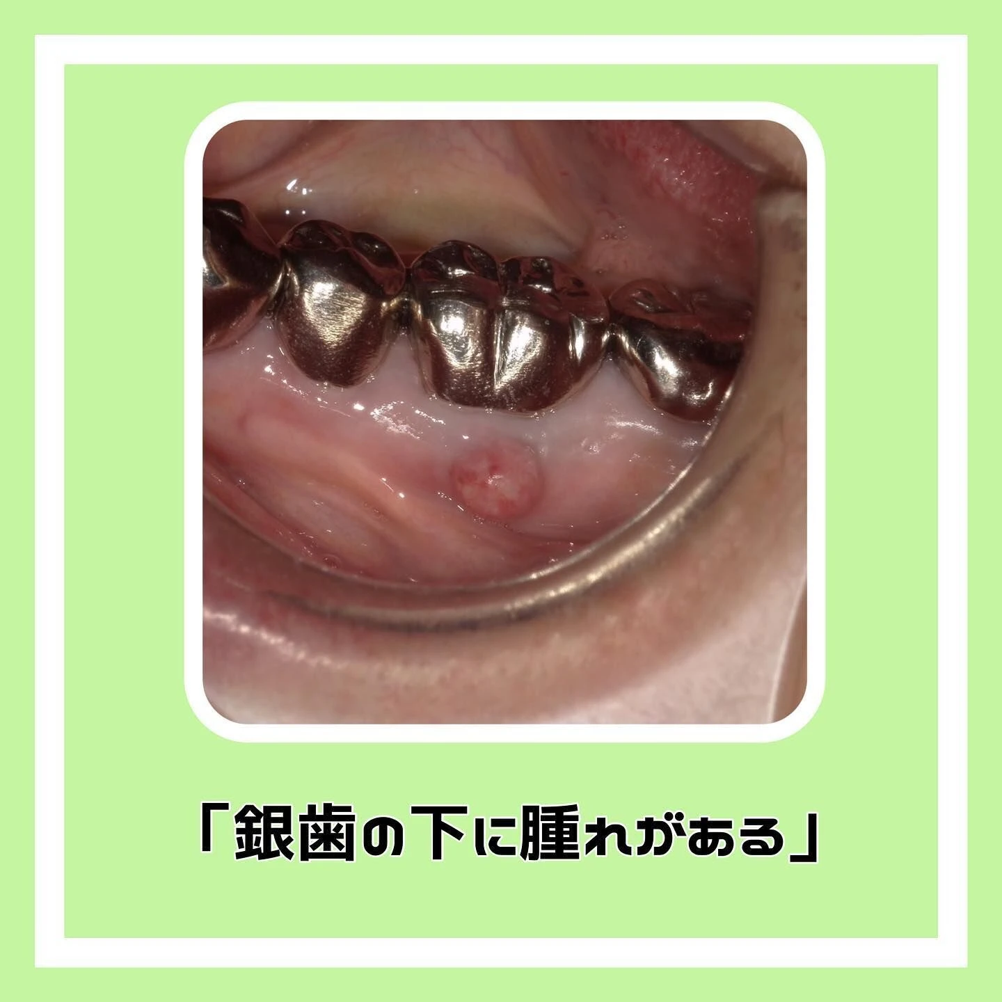 「根尖性歯周炎」について🦷