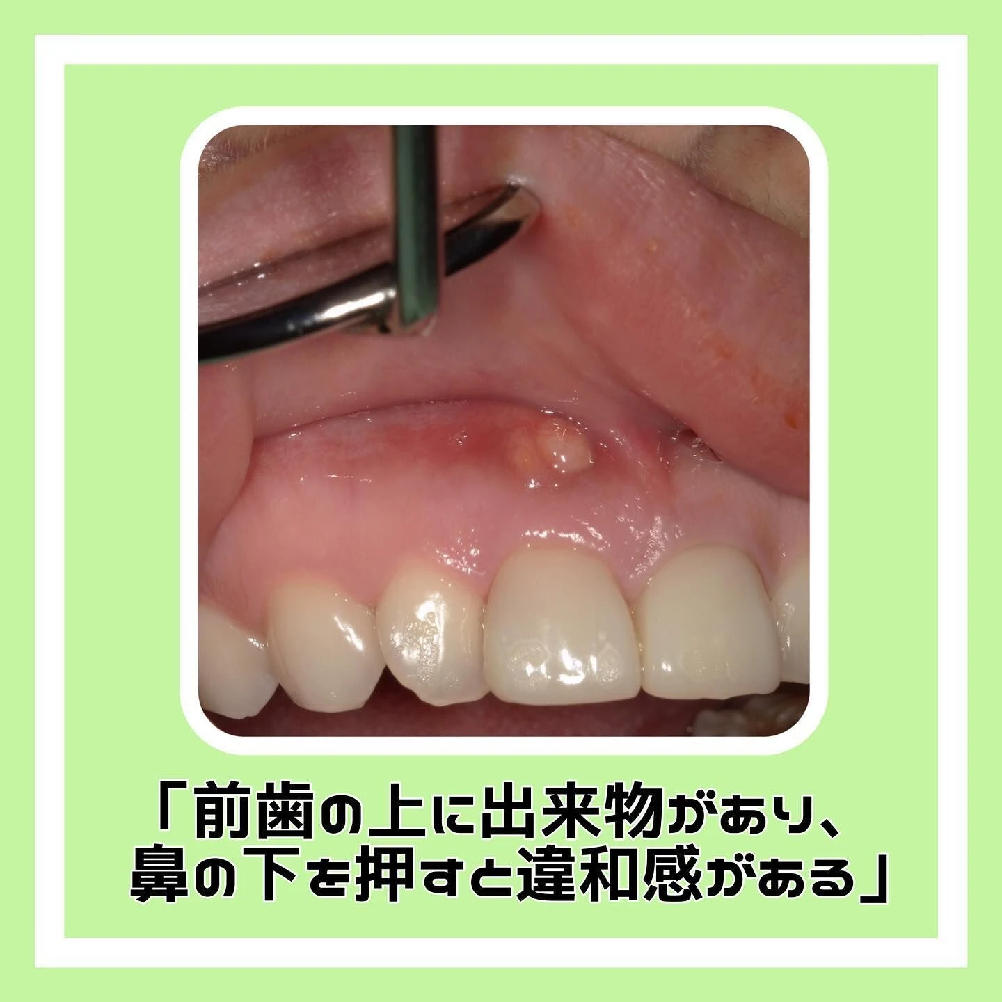 「根尖性歯周炎」について🦷