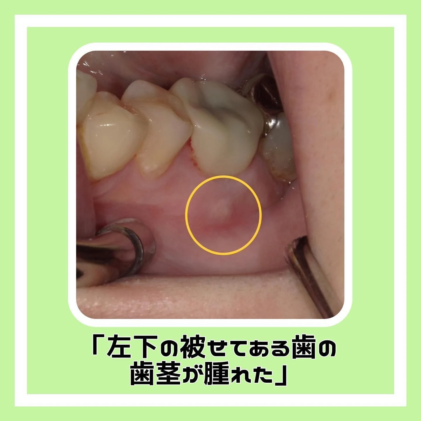 「根尖性歯周炎」について🦷