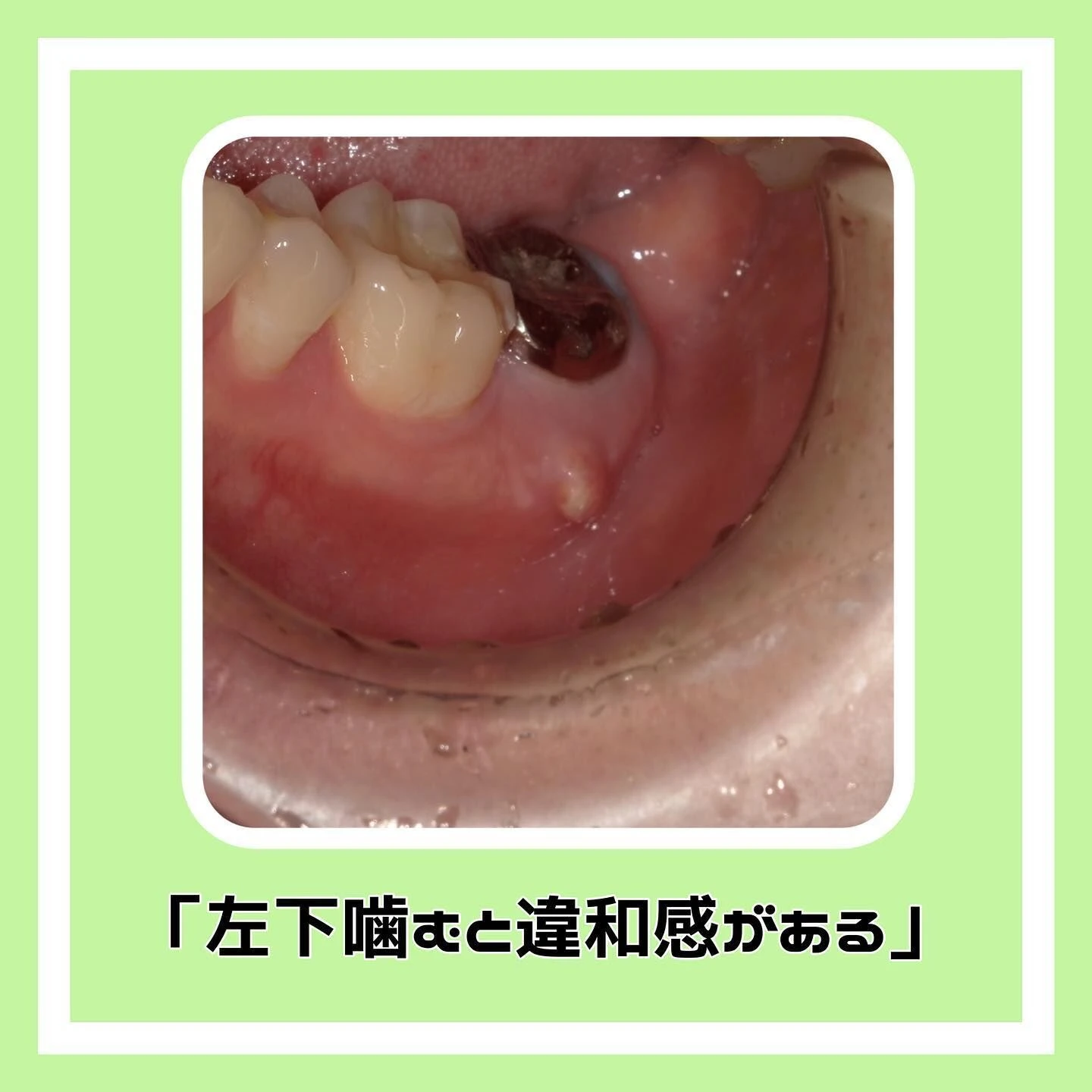 「根尖性歯周炎」について🦷