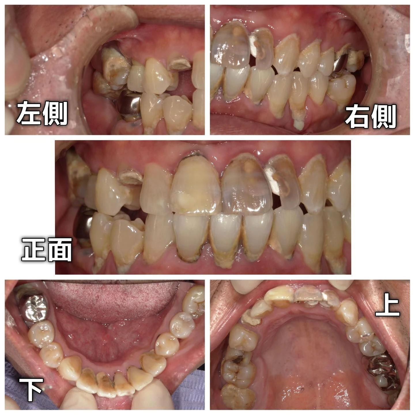 症例写真(Before/After)🦷