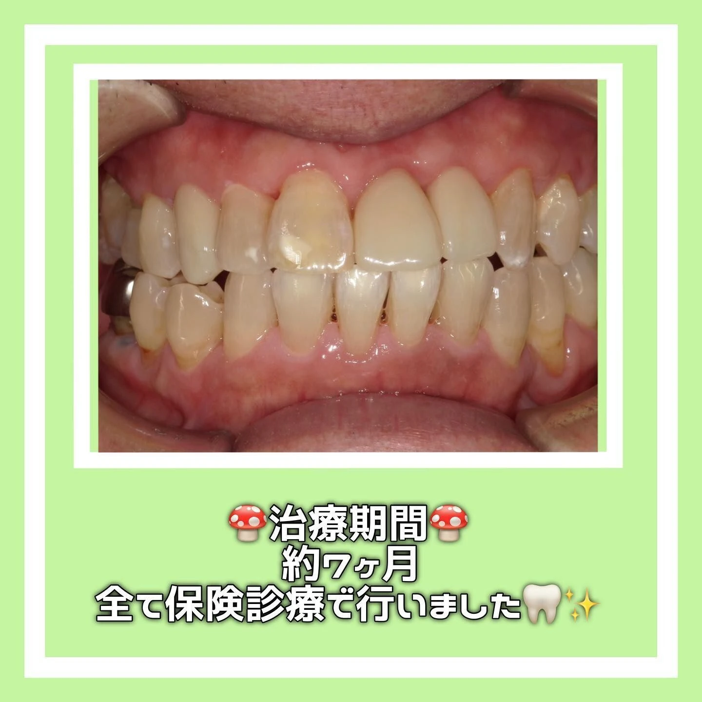 症例写真(Before/After)🦷