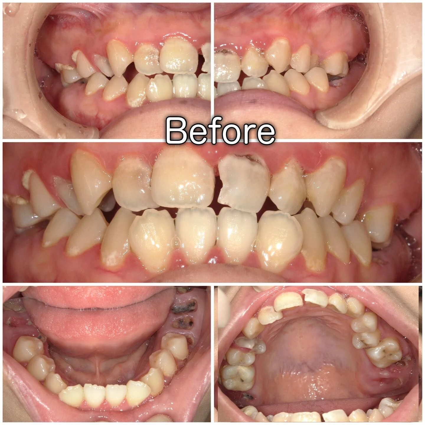 症例写真(Before/After)②🦷