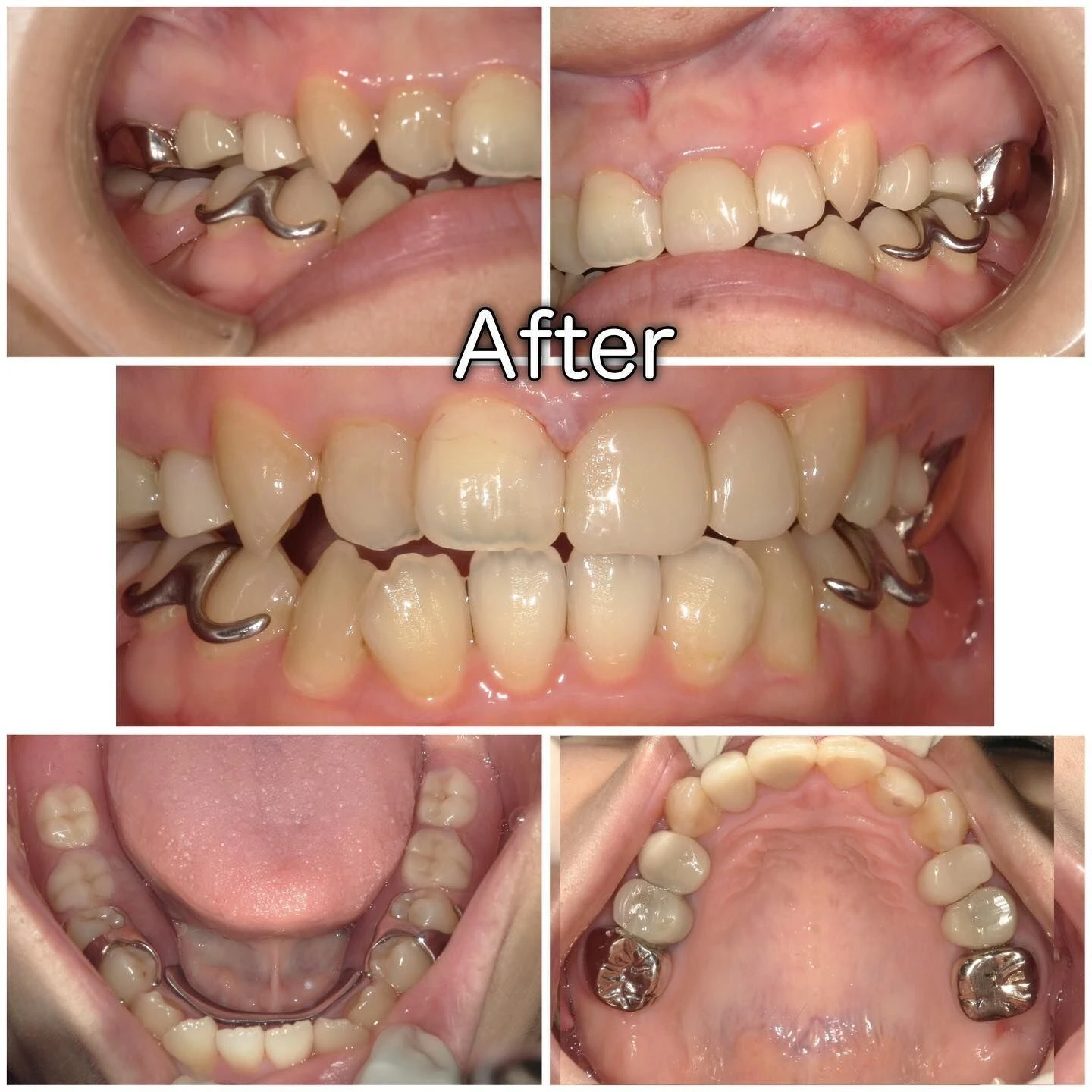 症例写真(Before/After)②🦷