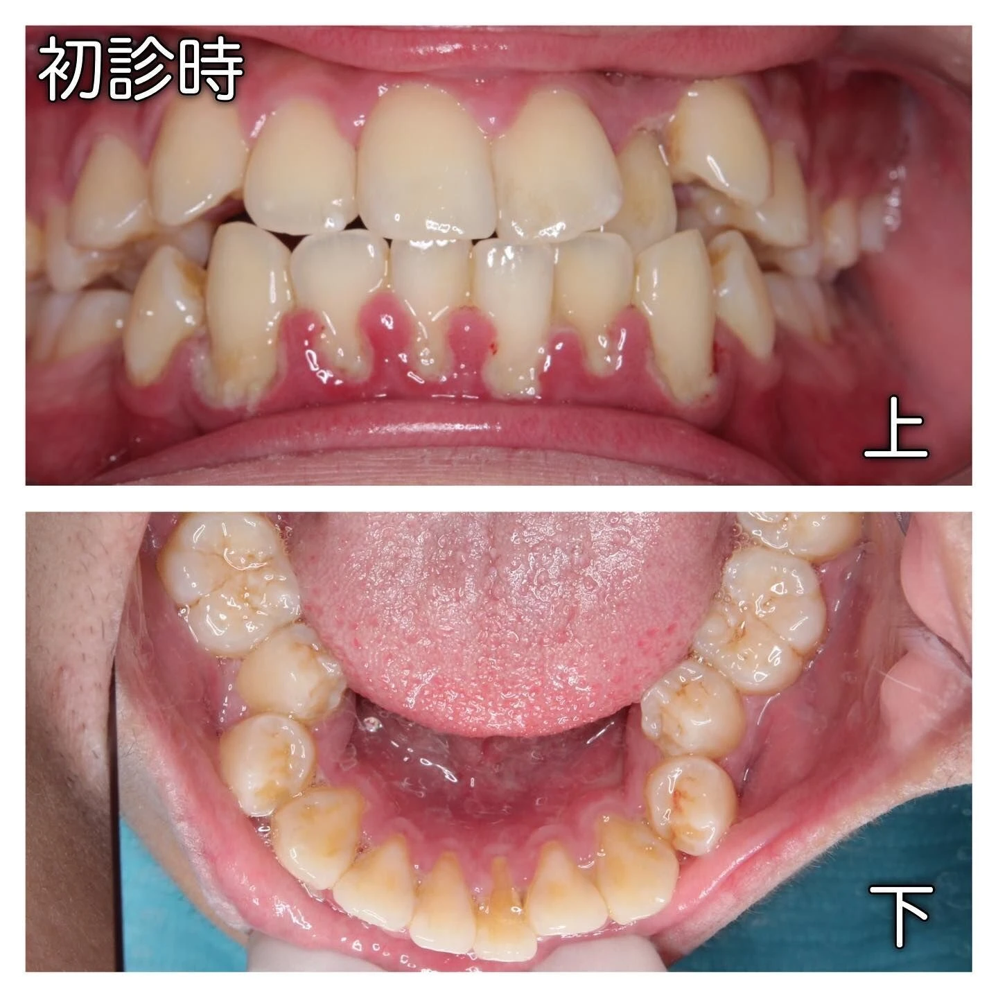 症例写真(Before/After)③🦷