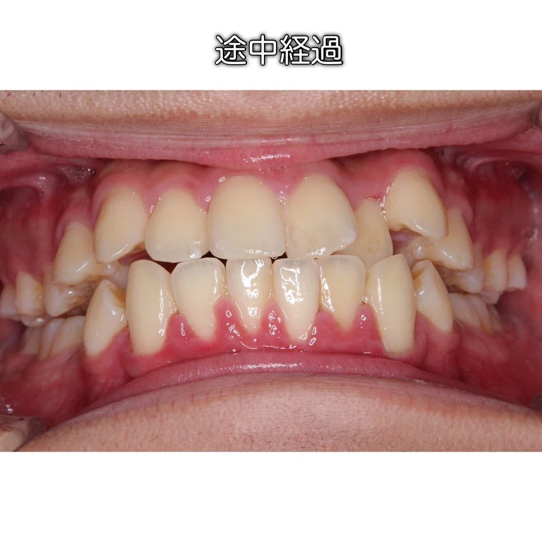 症例写真(Before/After)③🦷