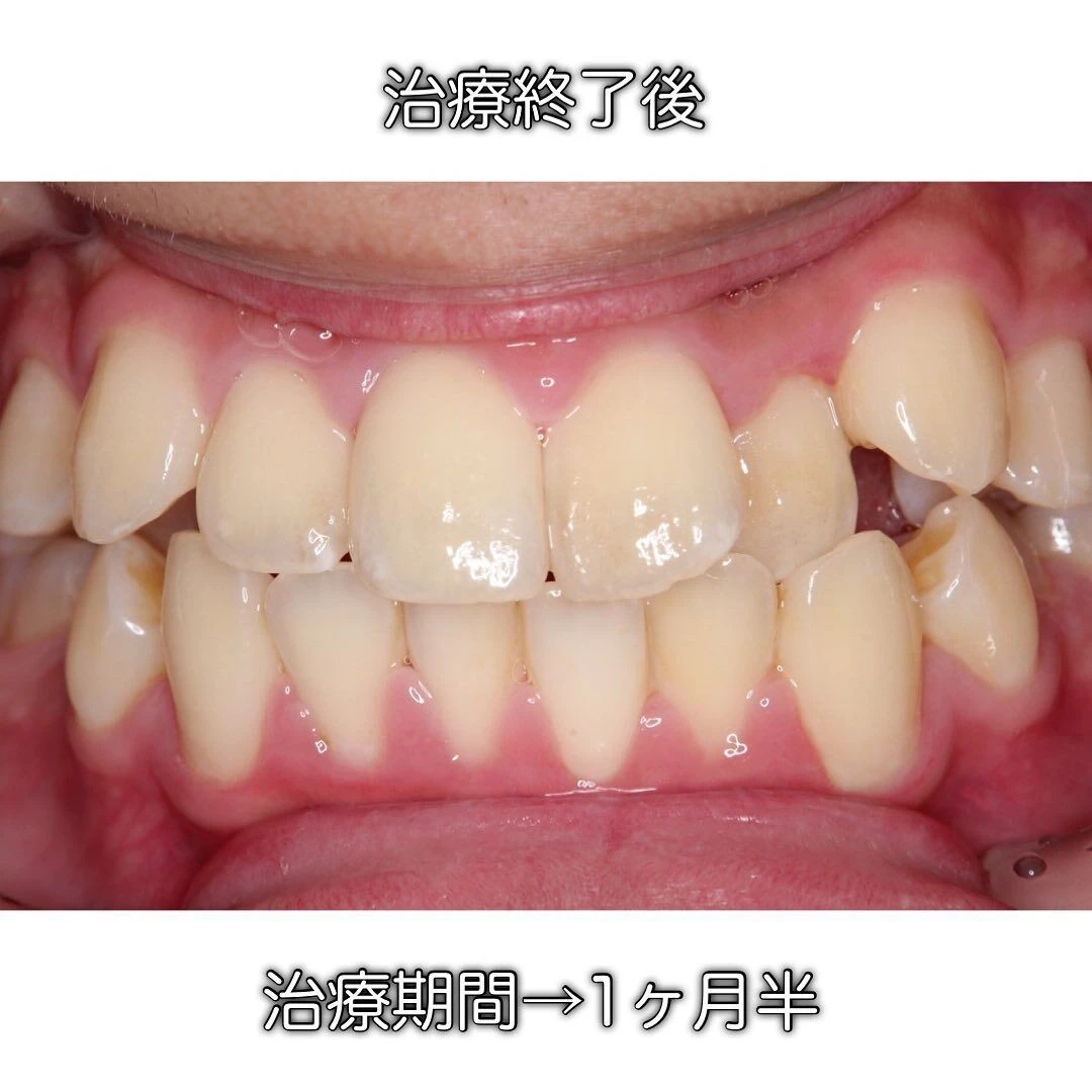 症例写真(Before/After)③🦷