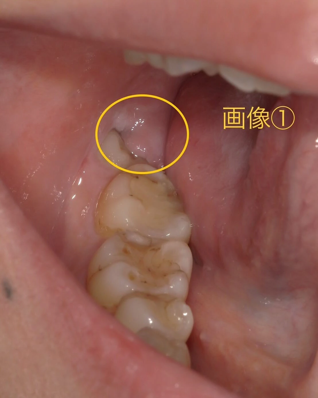 症例写真〜親知らずが痛い！〜