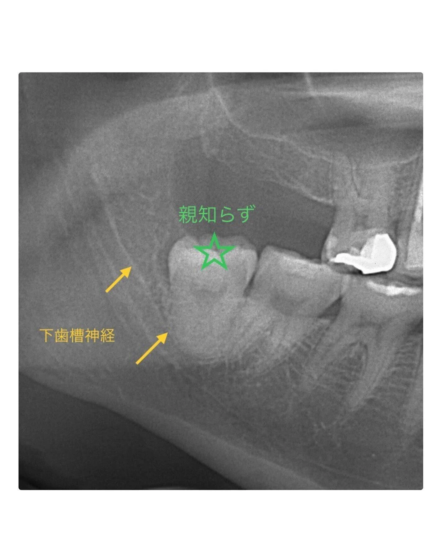 症例写真〜親知らずが痛い！〜