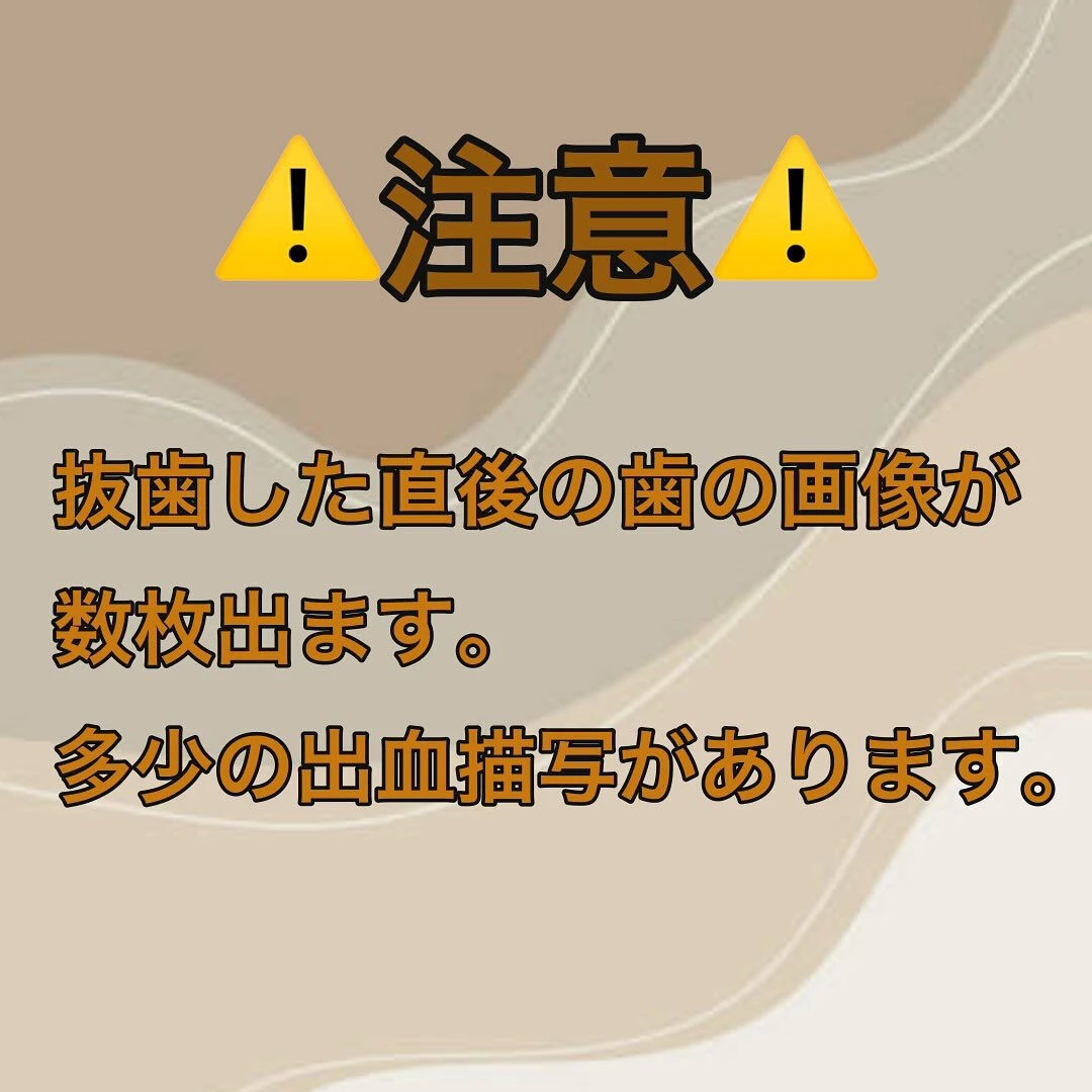 骨支持が不足している事により抜歯に至ったケースを紹介します🦷