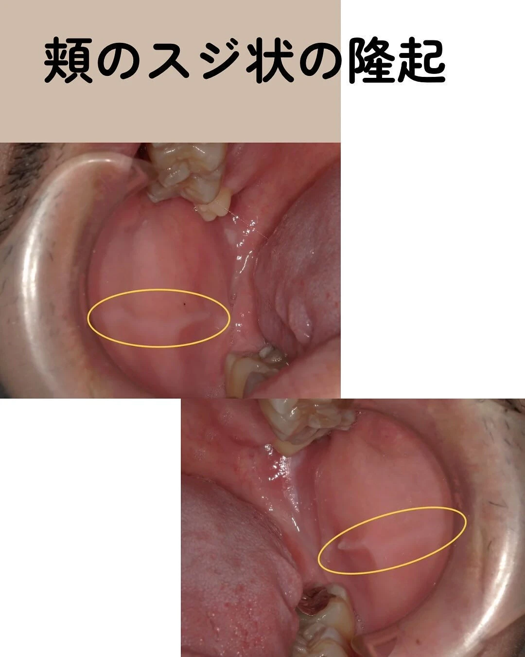 歯ぎしり・食いしばり していませんか？