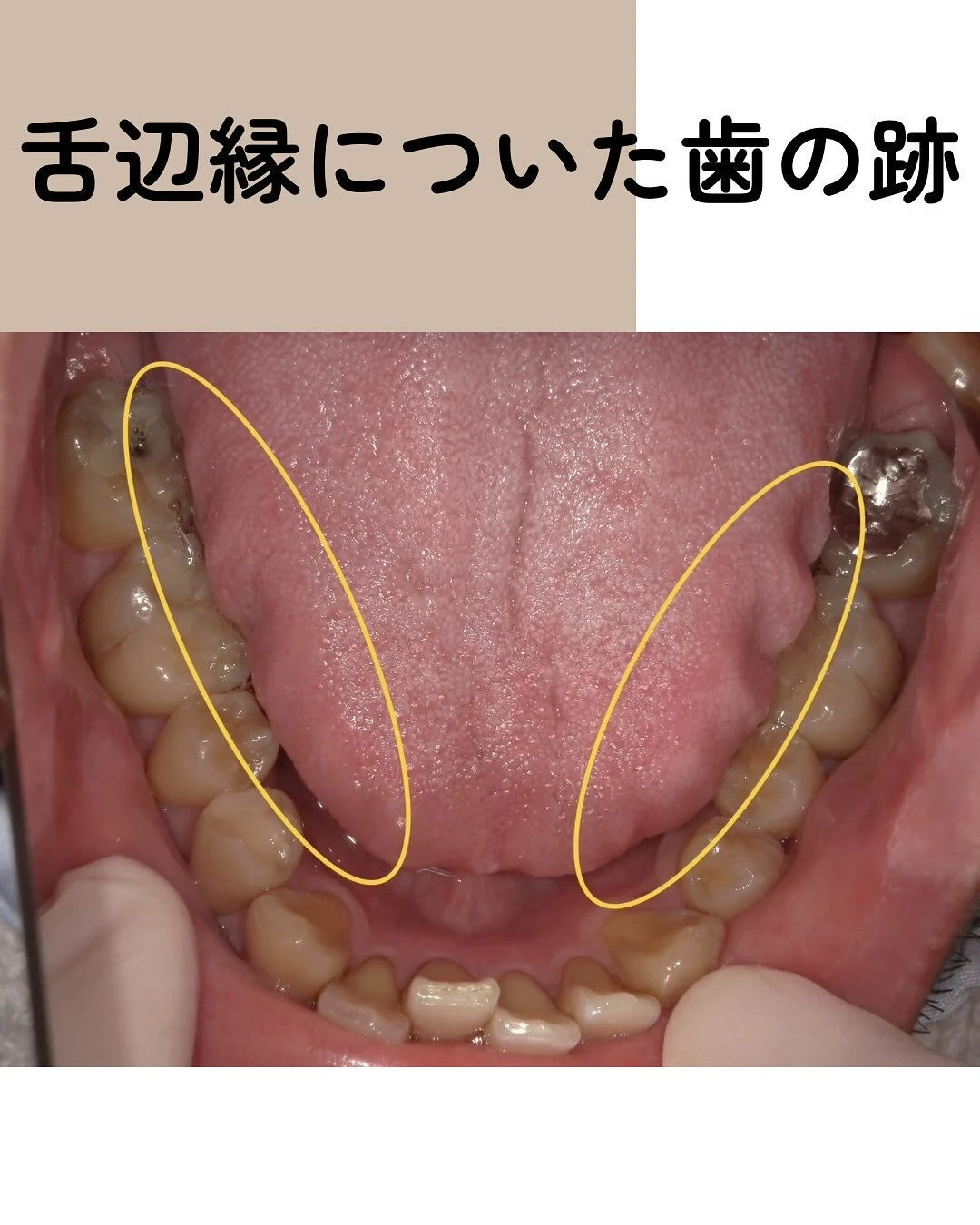 歯ぎしり・食いしばり していませんか？