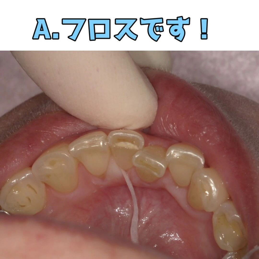 定期検診の際に汚れが目立っていたため当日に清掃指導と歯石取り...