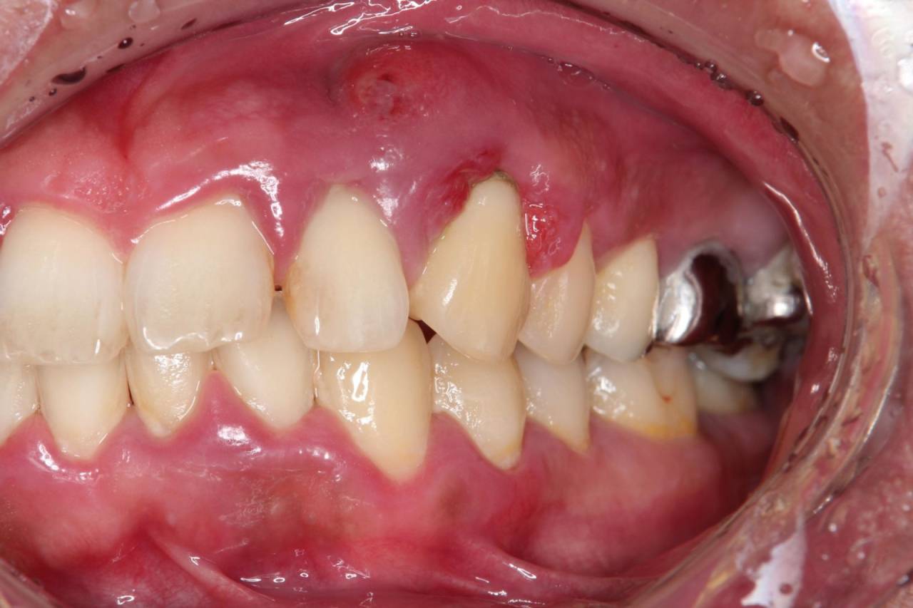 初診時の歯茎<br>左上の糸切り歯周囲の歯茎が大きく腫れているとのことで来院されました。歯周ポケットは8mm以上でした。