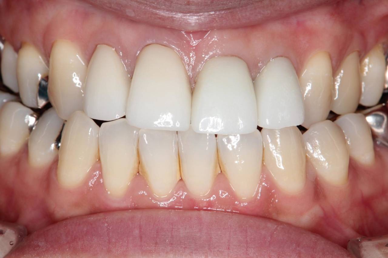 施術後の写真<br>歯の色が改善し、被蓋関係も改善されました。