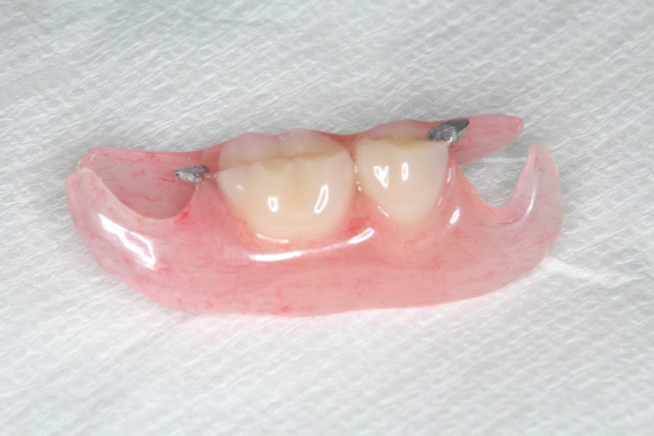 ノンクラスプデンチャー <br>保険の入れ歯のバネ (クラスプ) を無くした設計の入れ歯です。