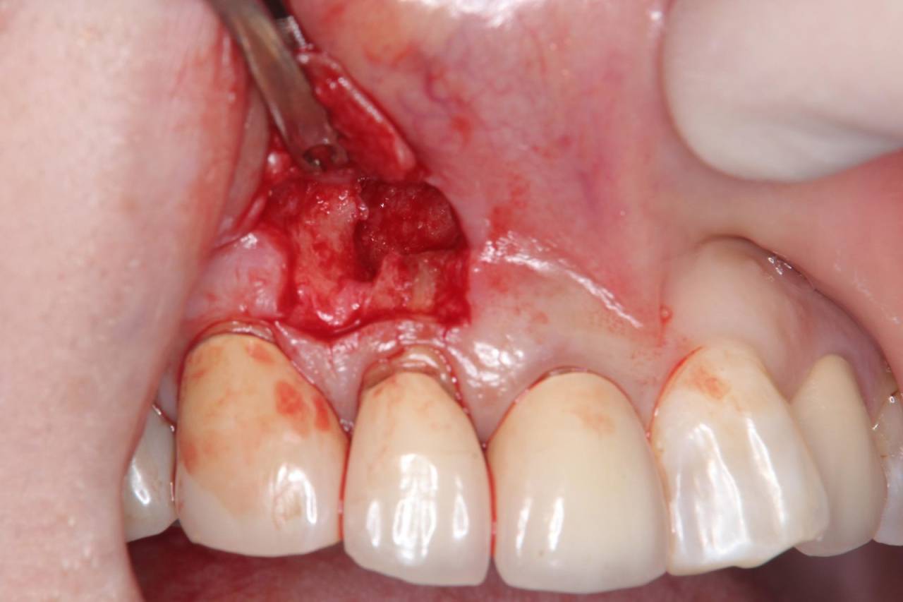 手術時<br>歯茎に切開を入れ、病巣部分の摘出手術を行いました。