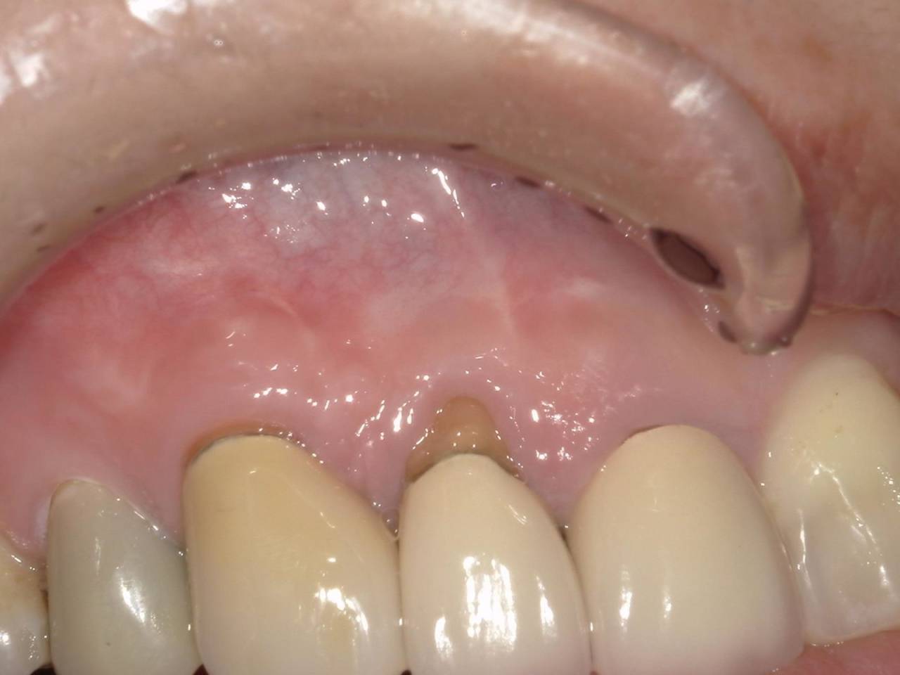 術後3ヶ月<br>歯茎の出来物は消失し、押しても痛みや違和感は完全に消失しております。