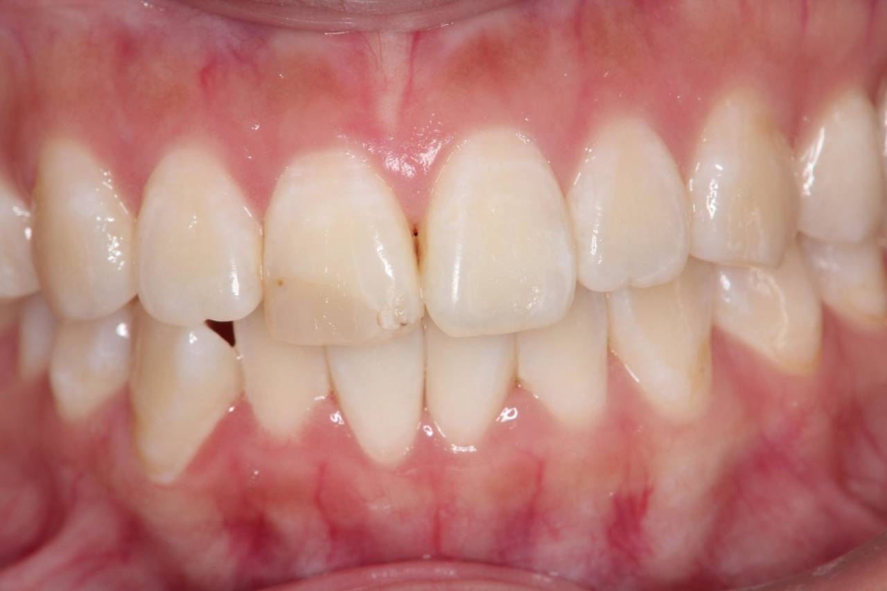 施術前 <br>前歯が折れ、つぎはぎ部分の色が合っていません。