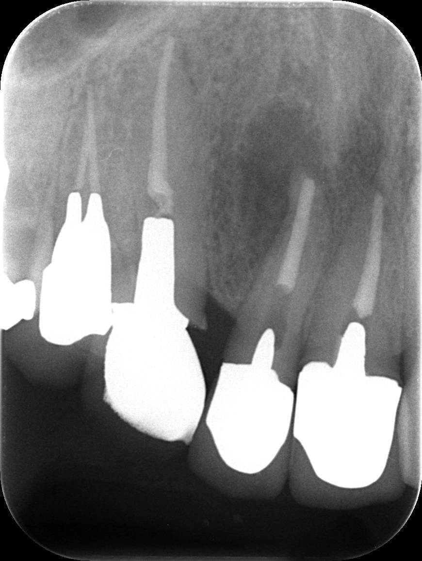 初診時レントゲン<br>右から2番目の根の先に黒い病巣を認めます。しかし、前歯の被せ物は壊さずに治療したいとのことでした。