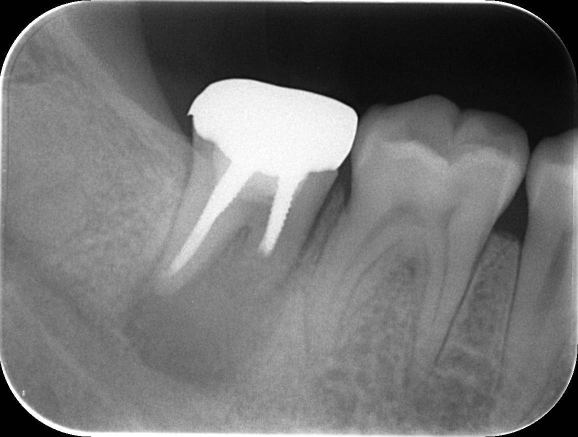 歯茎の腫れに対する家庭療法
