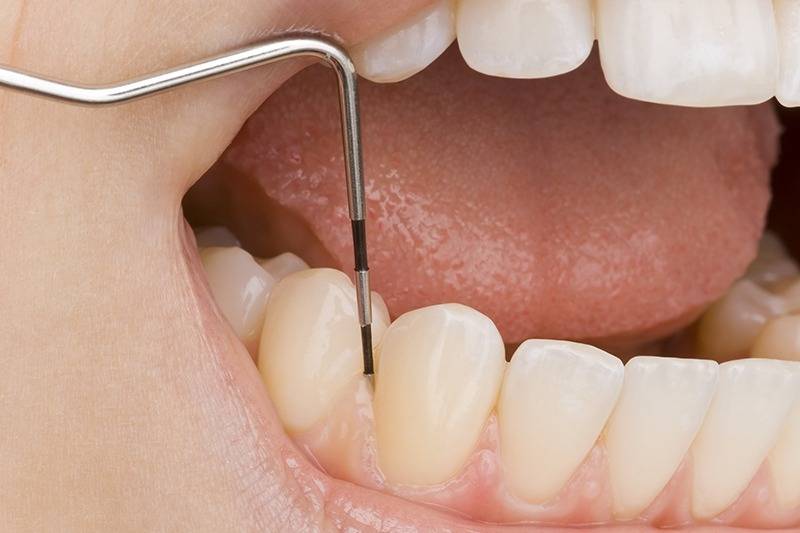 適切な治療と指導による歯周病ケア