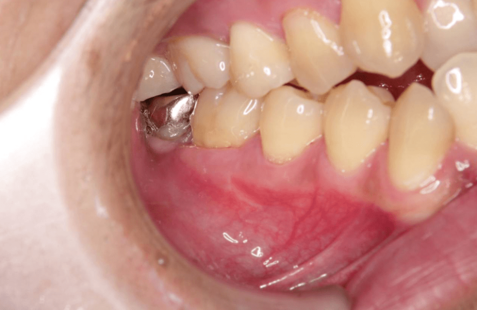 術後3ヶ月の歯茎<br>銀歯の手前の歯茎の膨らみが消え、術後の違和感も特に見られず、順調とのことでした。