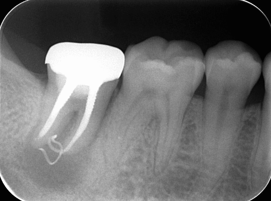 レントゲン写真<br>一度歯茎に消炎処置を行ったにも関わらず、症状が消退しなかったため、レントゲンを撮影したところ、根の先端に異常（異物混入）があることがわかりました。