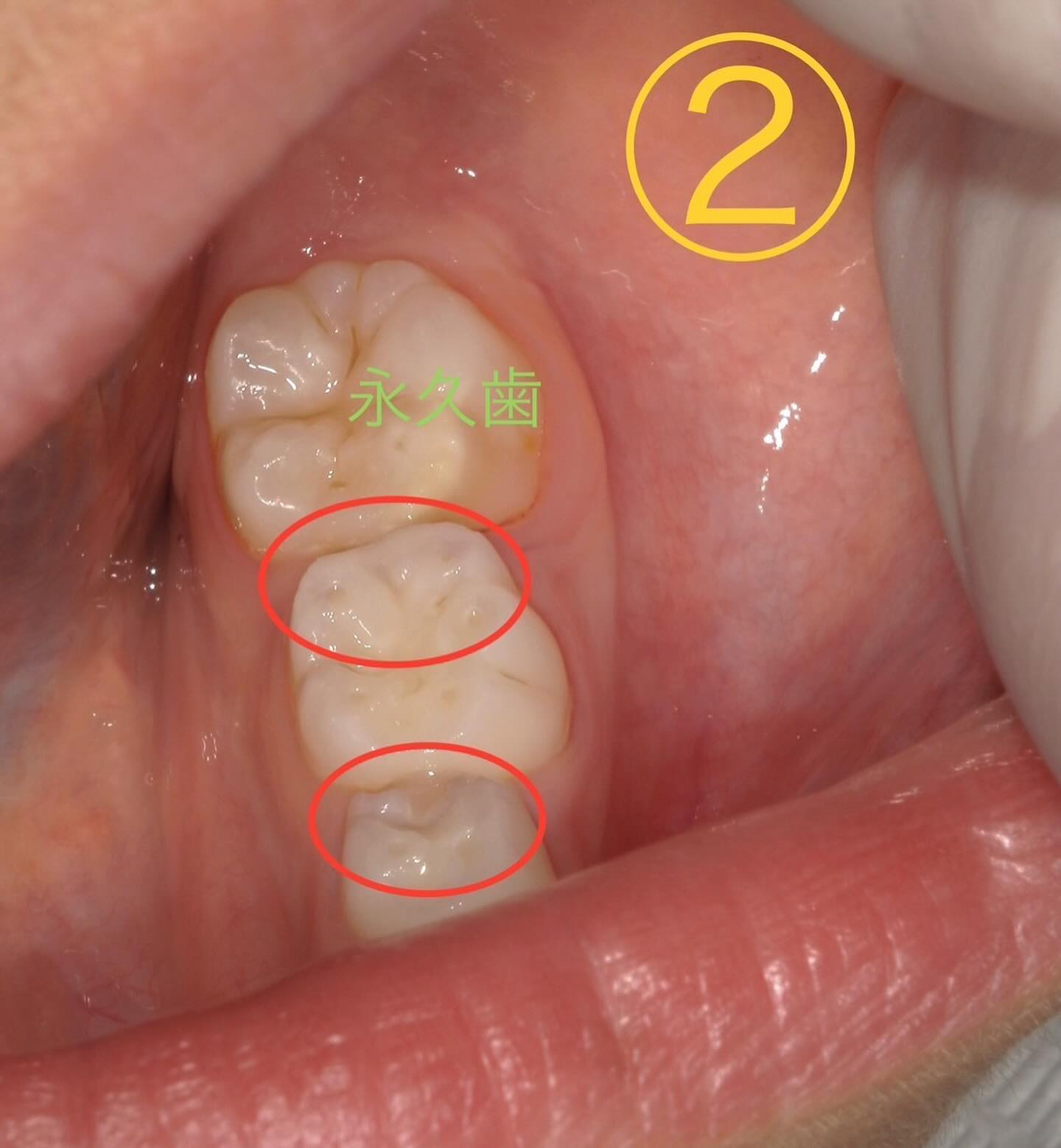 🧒パッと見分からない子どもの虫歯①👧