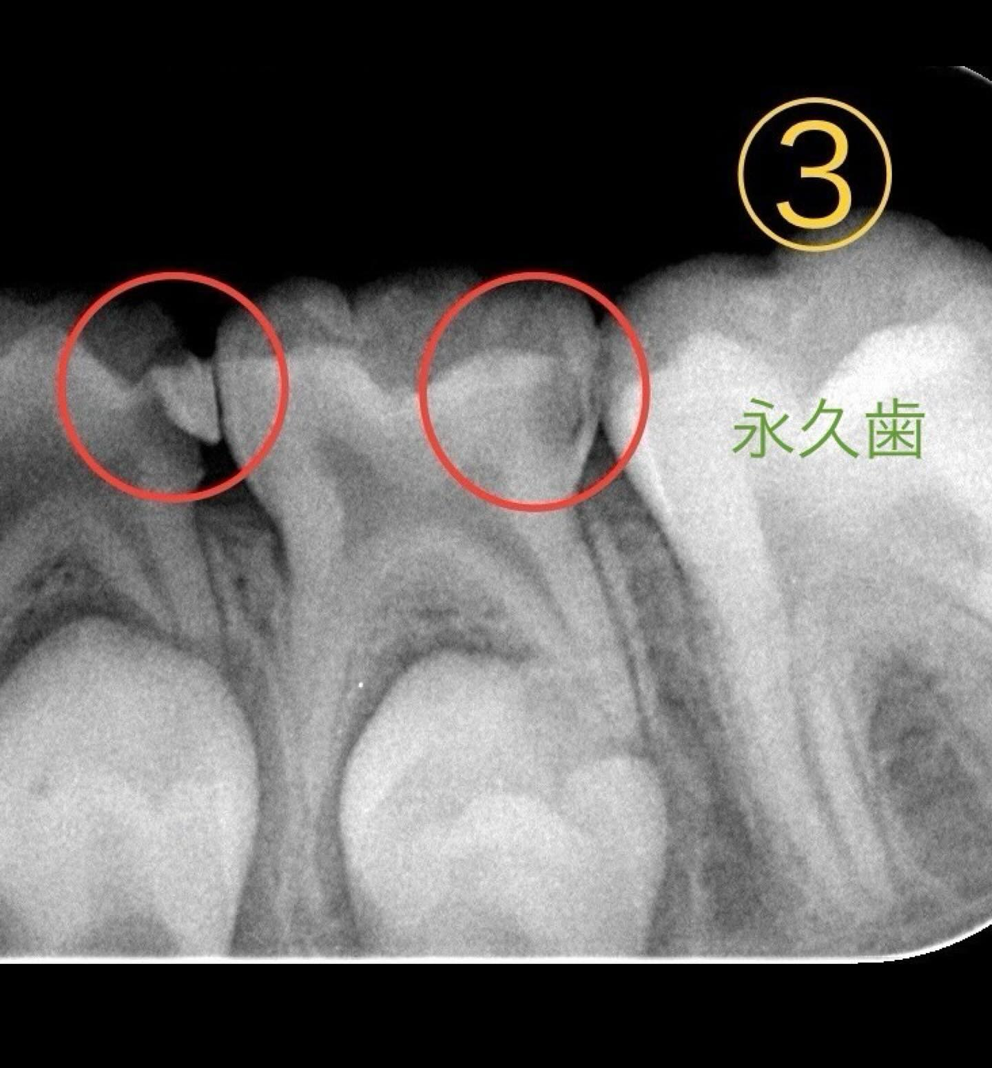 🧒パッと見分からない子どもの虫歯①👧