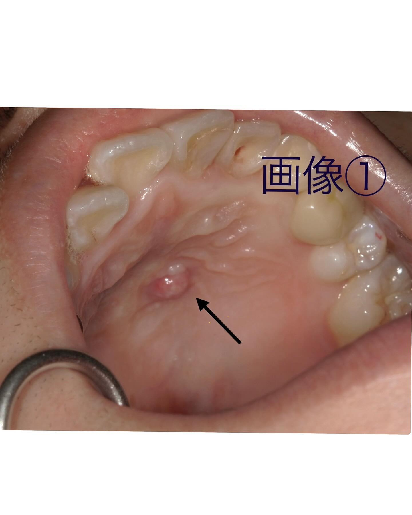 症例写真〜根尖病巣〜