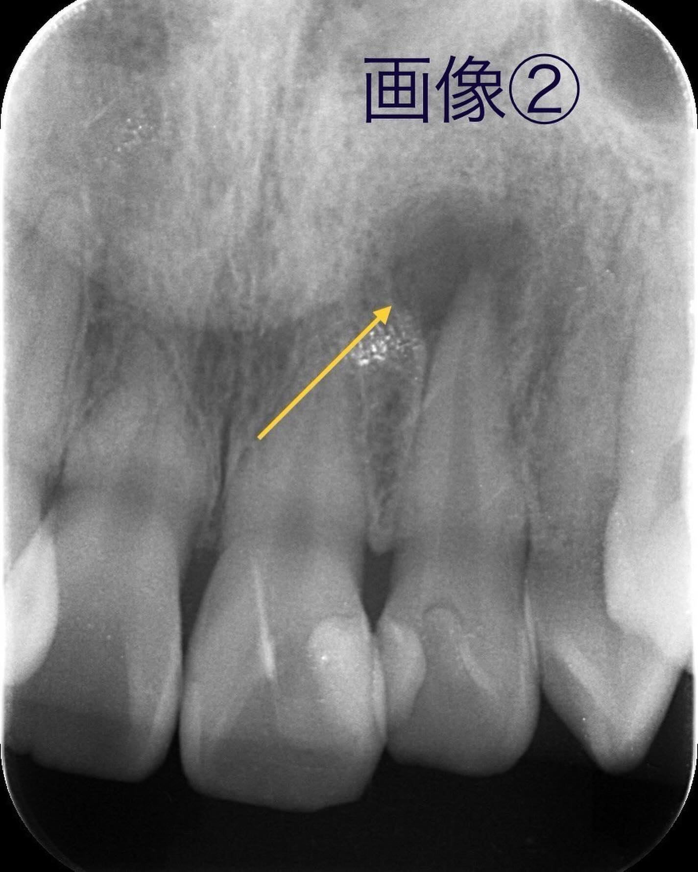 症例写真〜根尖病巣〜