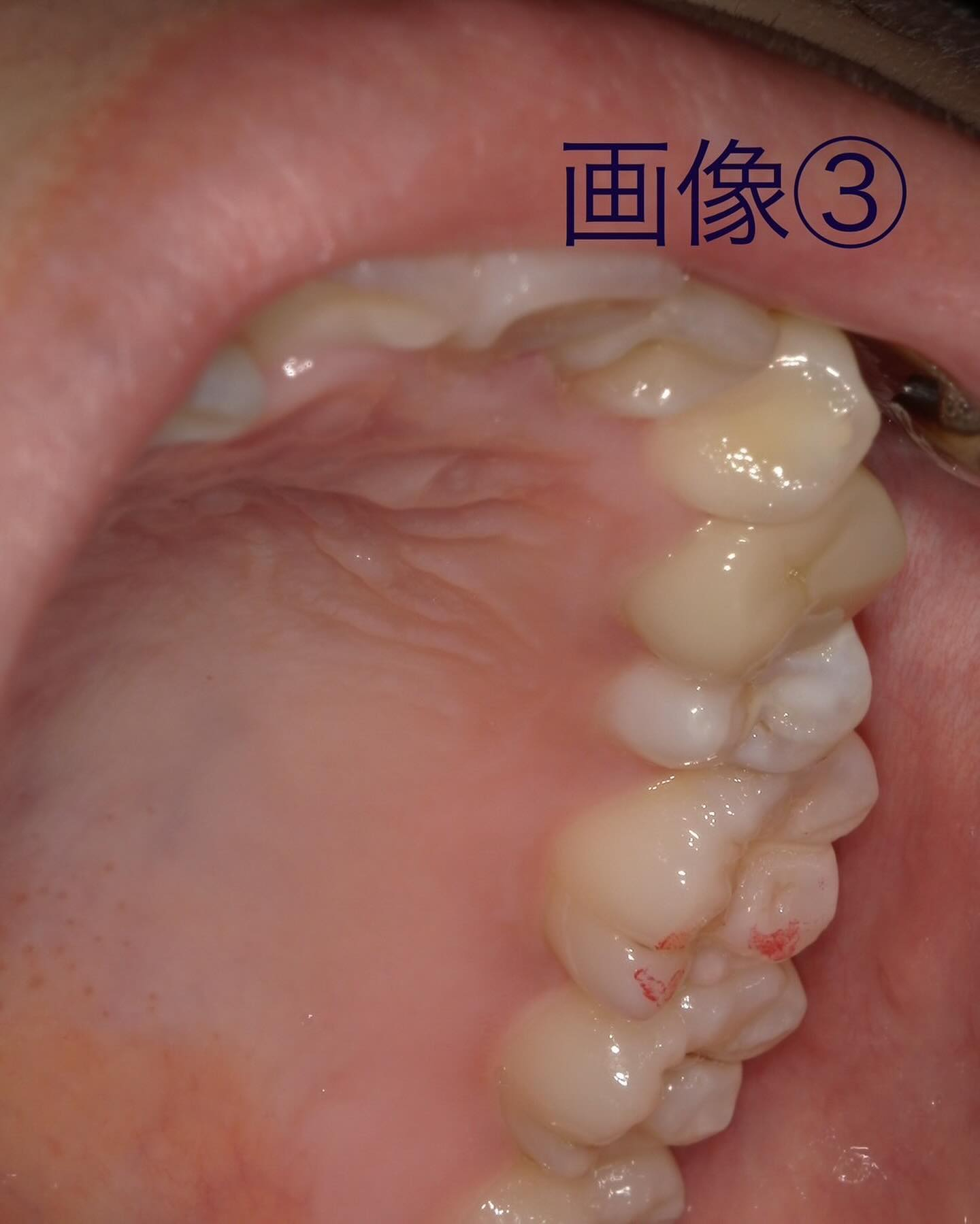 症例写真〜根尖病巣〜